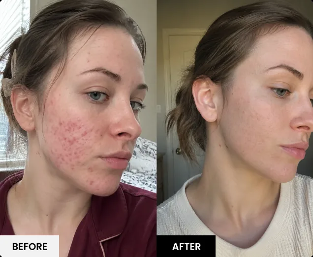 Before and after skin result 1