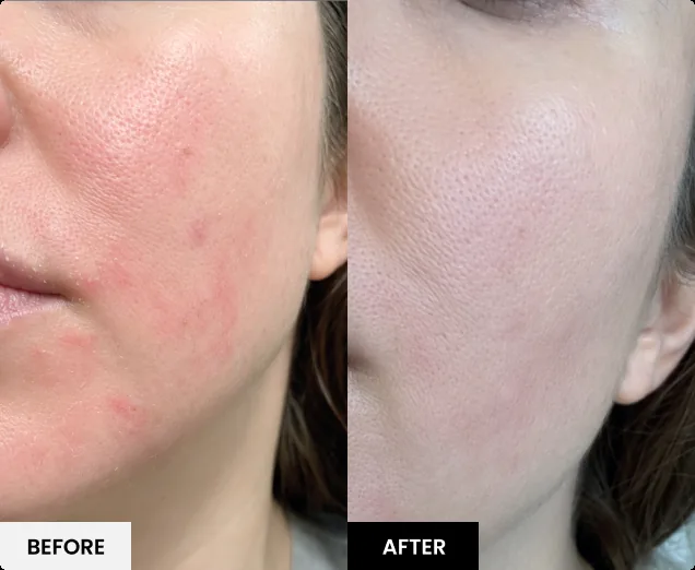 Before and after skin result 3