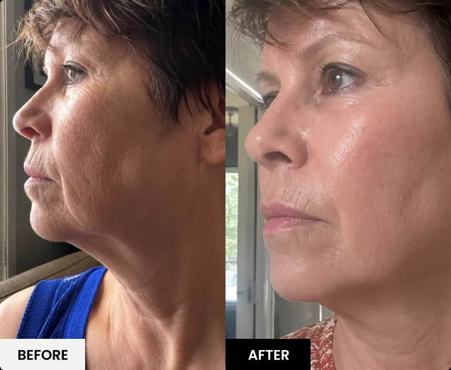 Before and after skin result 4