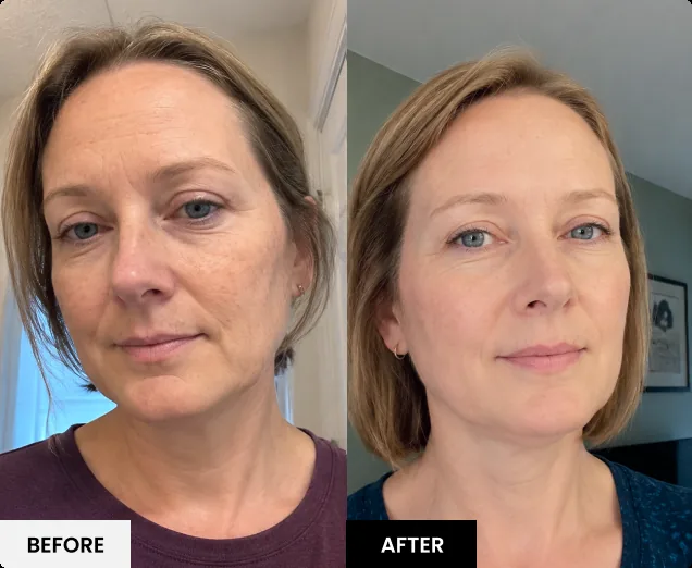 Before and after skin result 6