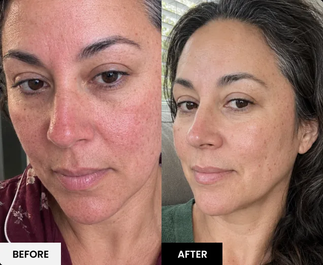 Before and after skin result 7