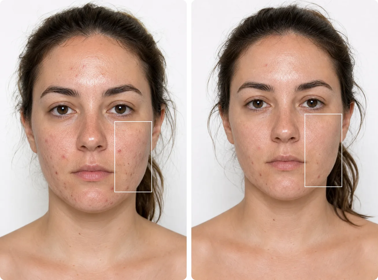 Before and after comparison for oily acne-prone skin with lingering dark spots
