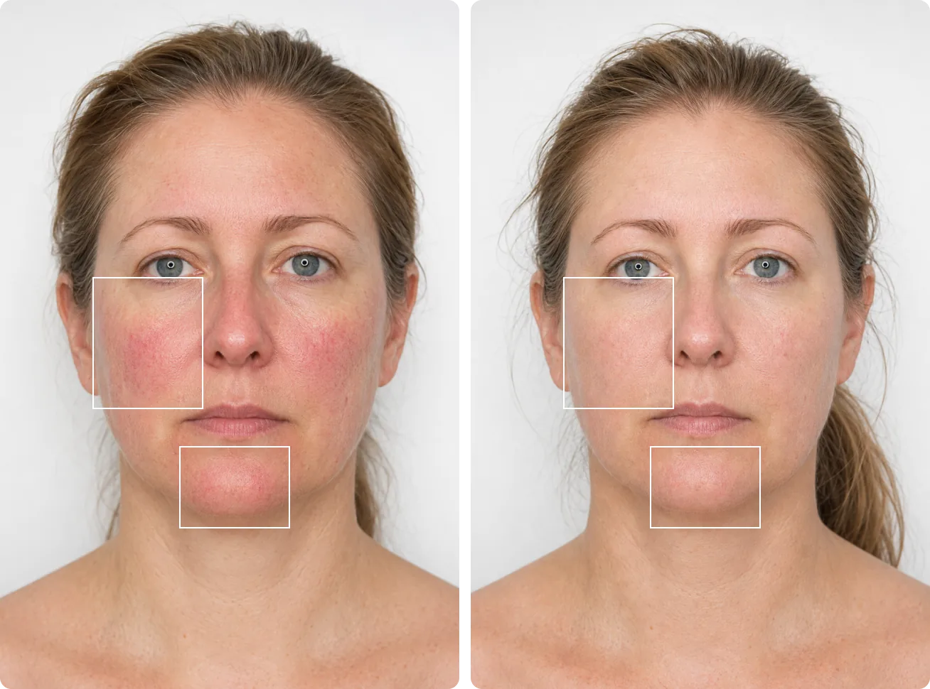 Before and after comparison for sensitive skin prone to flushing and irritation
