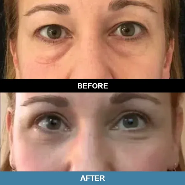 EyeRenew Pro before and after