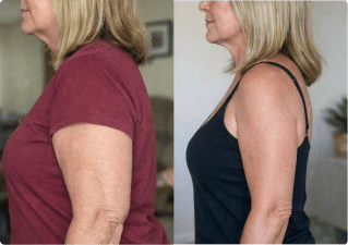 Before and after upper arms