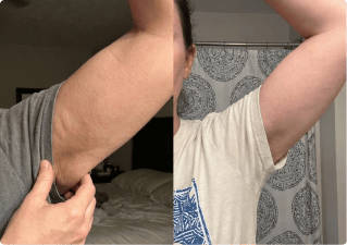 Before and after arm profile